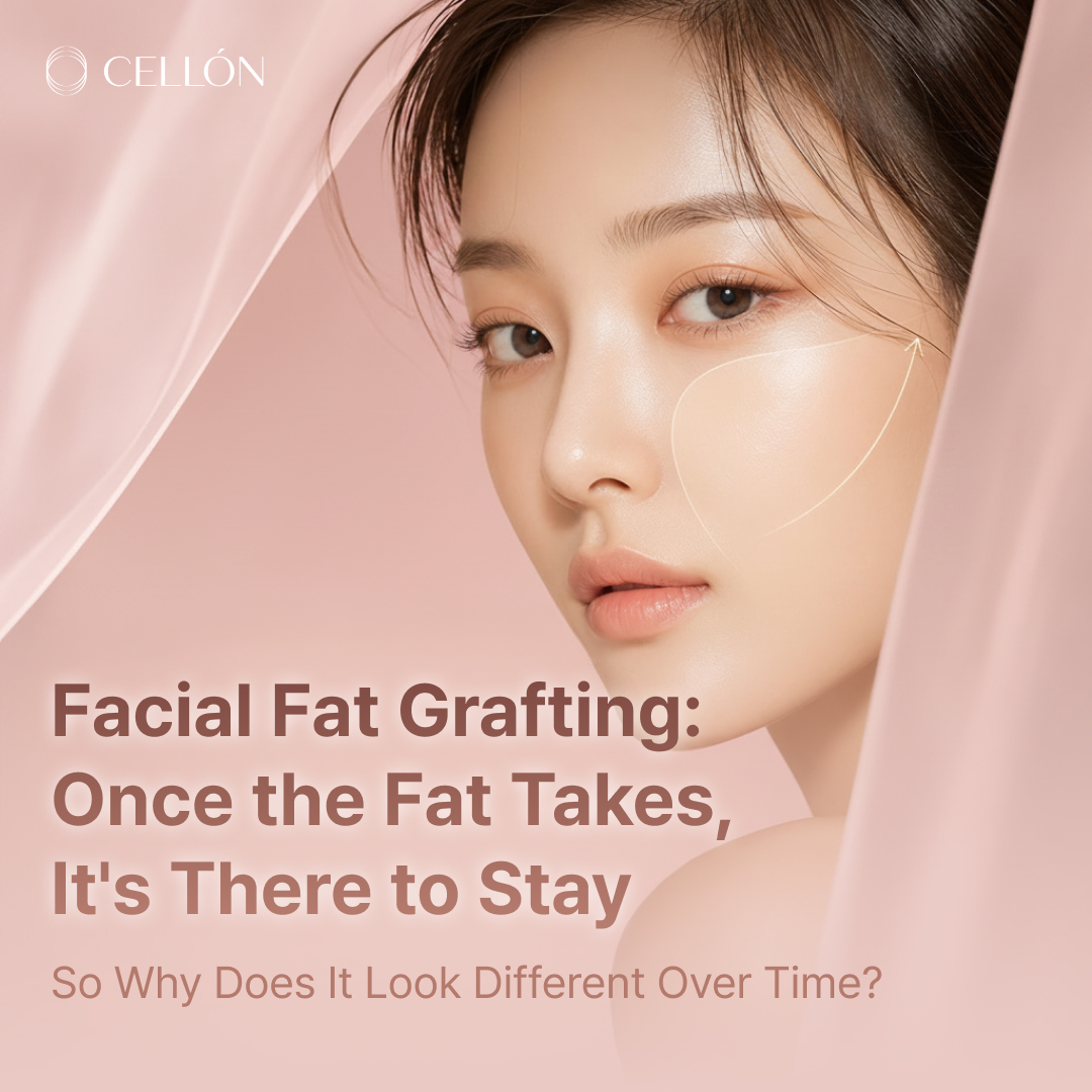 Facial Fat Grafting: Once the Fat Takes, It's There to Stay — So Why Does It Look Different Over Time?