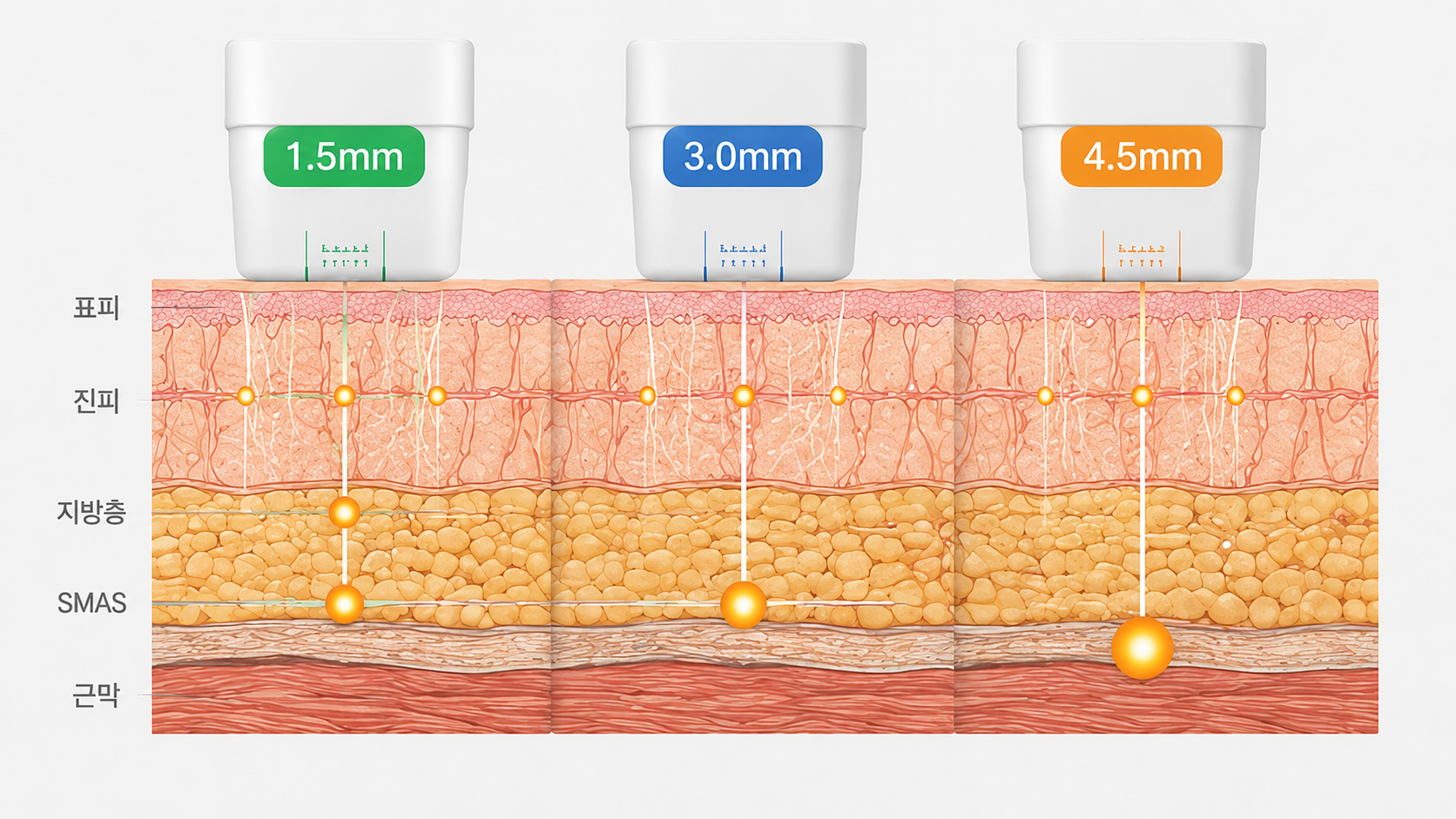 Ultherapy Prime vs. Classic Ultherapy: What's Actually Different?