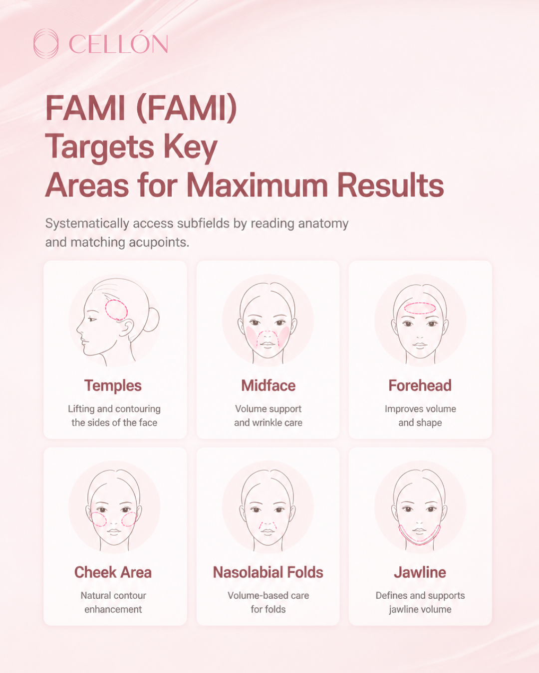 FAMI Fat Grafting: A Zone-by-Zone Strategy — Why Anatomy Determines Results