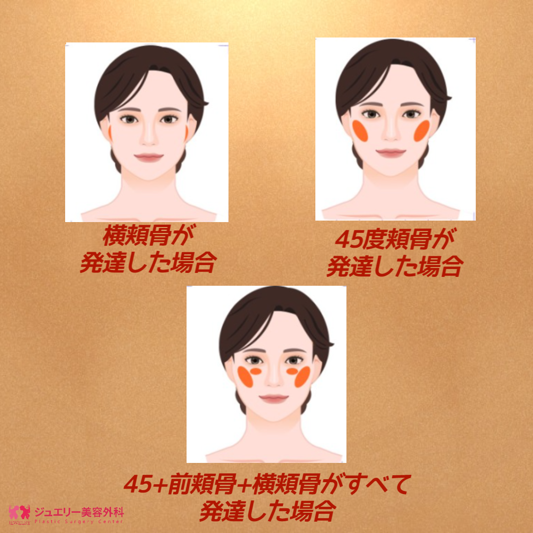 デコボコしたフェイスライン改善・輪郭2点 エラ+頬骨縮小003 | ジュエリー美容外科 頬骨縮小ケース別効果