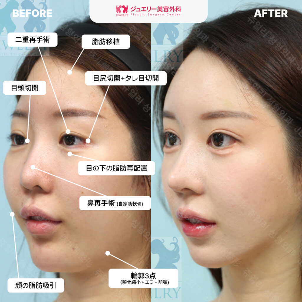 大阪カウンセリング会+目鼻顔の輪郭脂肪移植+トータル整形+韓国整形 4 | ジュエリー美容外科 ジュエリー美容外科での整形手術のビフォーアフター画像。ビフォー画像には、「脂肪移植」「二重再手術」「目頭切開」「目尻切開+タレ目切開」「目の下の脂肪再配置」「鼻再手術(自家肋軟骨)」「顔の脂肪吸引」「輪郭3点(頬骨縮小+エラ+前顎)」の手術箇所がテキストで示されている。