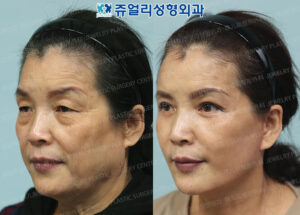 切開リフト+ジュエリー美容外科+韓国整形外科+韓国整形+前後写真+韓国美容手術 | ジュエリー美容外科
