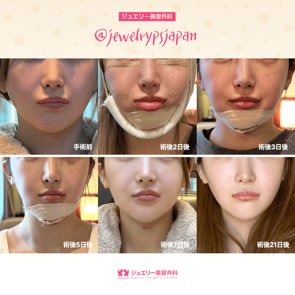 인스타 컨텐츠 04 | ジュエリー美容外科
