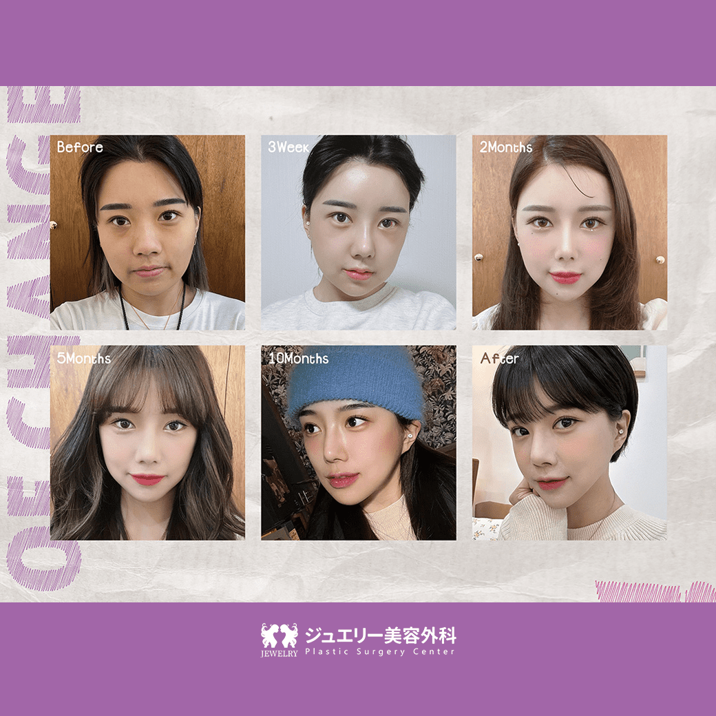 ジュエリー美容外科-顔面輪郭-脂肪移植-鼻整形-目整形-モデル (4) | ジュエリー美容外科 ジュエリー美容外科の手術後から3週間、2ヶ月、5ヶ月、10ヶ月、1年まで時間が経つにつれて見える美しさ
