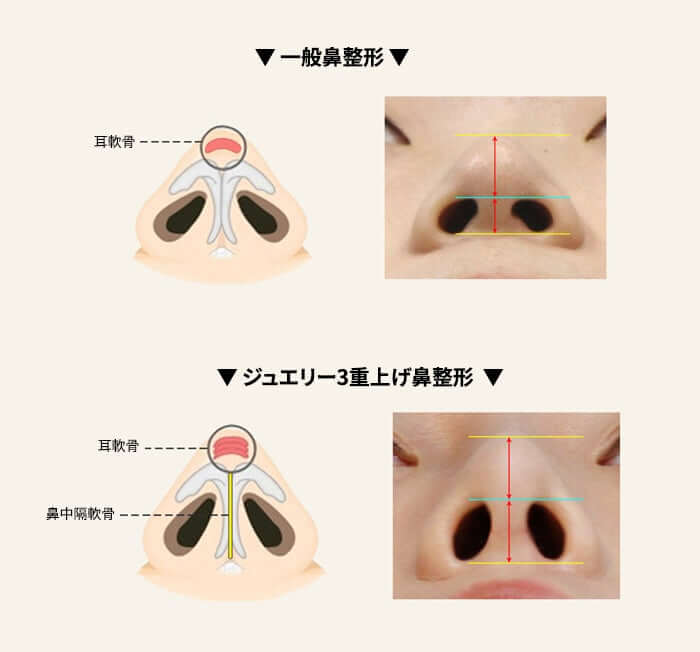 韓国 鼻整形 おすすめ_05 | ジュエリー美容外科 韓国 鼻整形 おすすめ