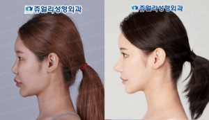 輪郭3点+韓国整形外科+韓国整形+前後写真+韓国美容手術 | ジュエリー美容外科