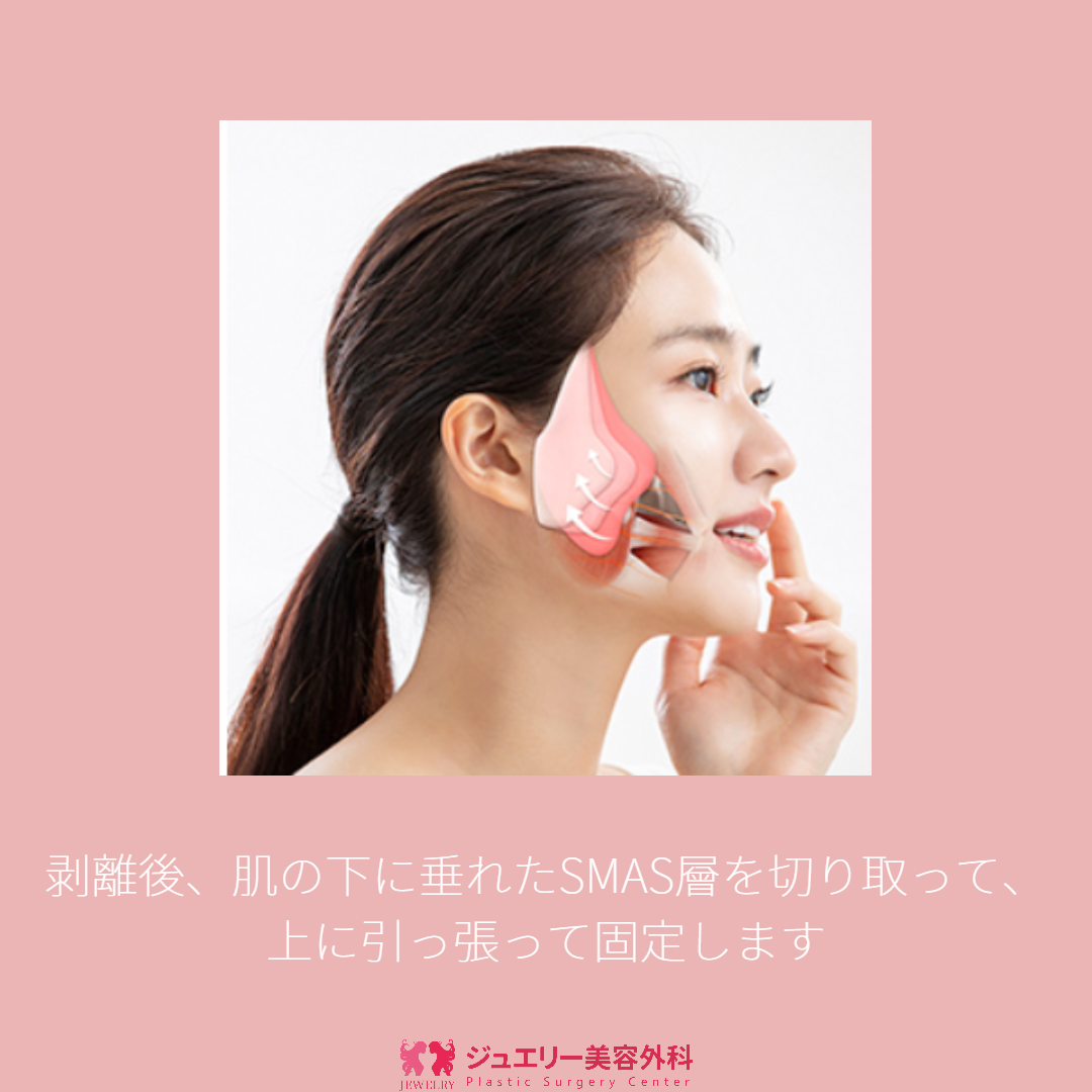 童顔になる秘密!ジュエリー韓国切開リフト005 | ジュエリー美容外科 剥離後、肌の下に垂れたSMAS層を切り取って、上に引っ張って固定します