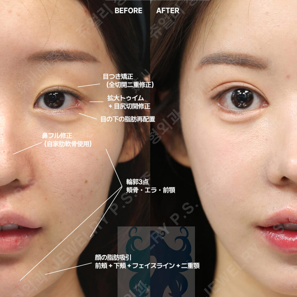 12 顔の脂肪吸引 | ジュエリー美容外科 顔の左右が比較された施術前後写真。若い女性に見え、顔の輪郭やバランスの変化が示されている。ジュエリー美容外科のロゴは一部隠れており、内容は顔の美容施術に関するもの。