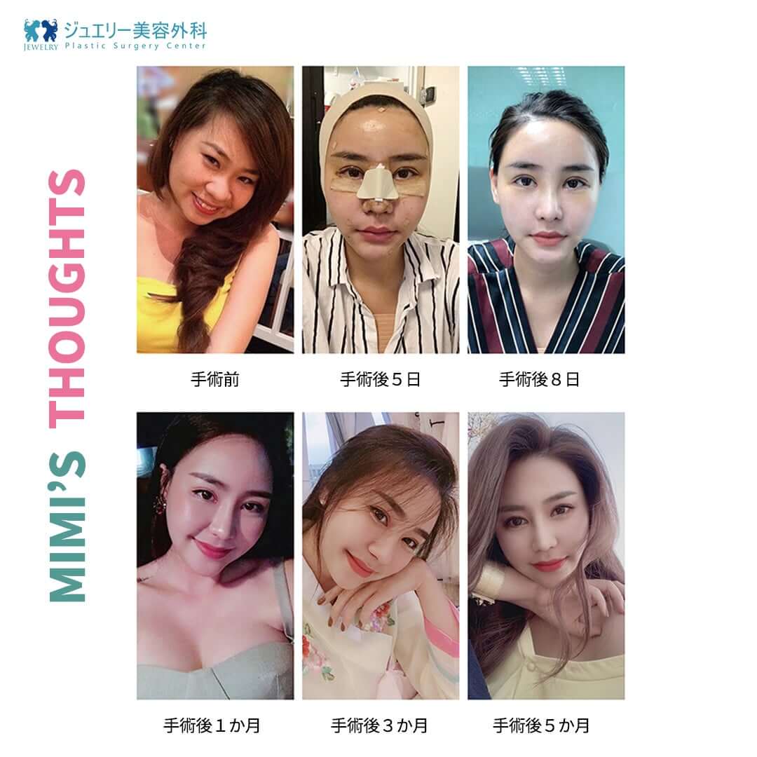 韓国豊胸整形