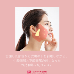 切開した部位から皮膚の下を剥離しながら、中顔面部と下顔面部の弱くなった保持靭帯を切ります