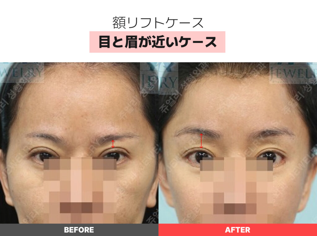 01-02 目と眉が近いケース | ジュエリー美容外科 額リフトのビフォーアフター。目と眉の距離が近いケースの改善例。術後は眉の位置が高くなることで、まぶたの被さりが解消され、二重のラインがよりはっきりと見えるようになっています。