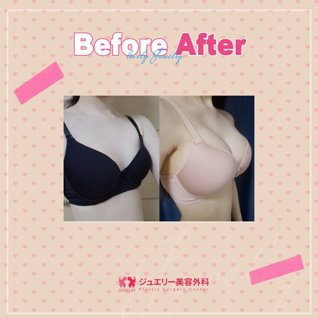 豊胸 | リアルストーリー