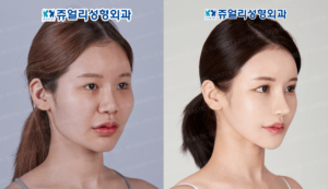 輪郭ジュエリー美容外科