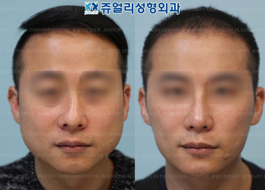 韓国顔面輪郭2点