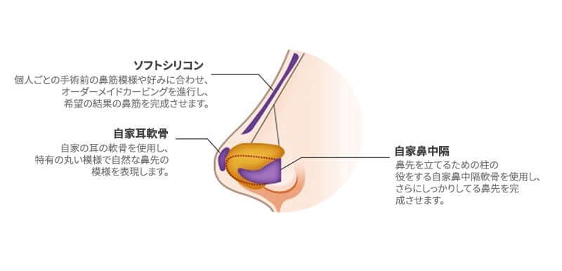 韓国 鼻整形 おすすめ_04 | ジュエリー美容外科 韓国 鼻整形 おすすめ