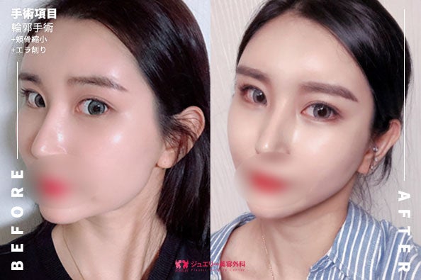 ジュエリー美容外科-顔面輪郭-前後写真 (2) | ジュエリー美容外科 ジュエリー美容外科の顔面輪郭の最終前後写真