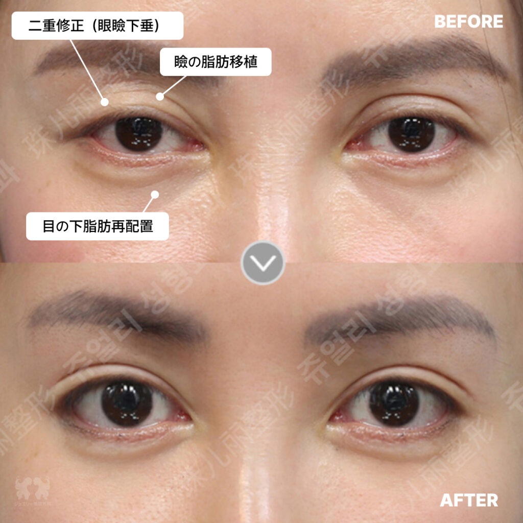 03 二重修正眼瞼下垂+瞼の脂肪移植+目の下脂肪再配置 | ジュエリー美容外科