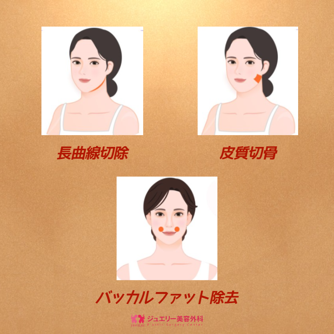 デコボコしたフェイスライン改善・輪郭2点 エラ+頬骨縮小002 | ジュエリー美容外科 エラ手術効果