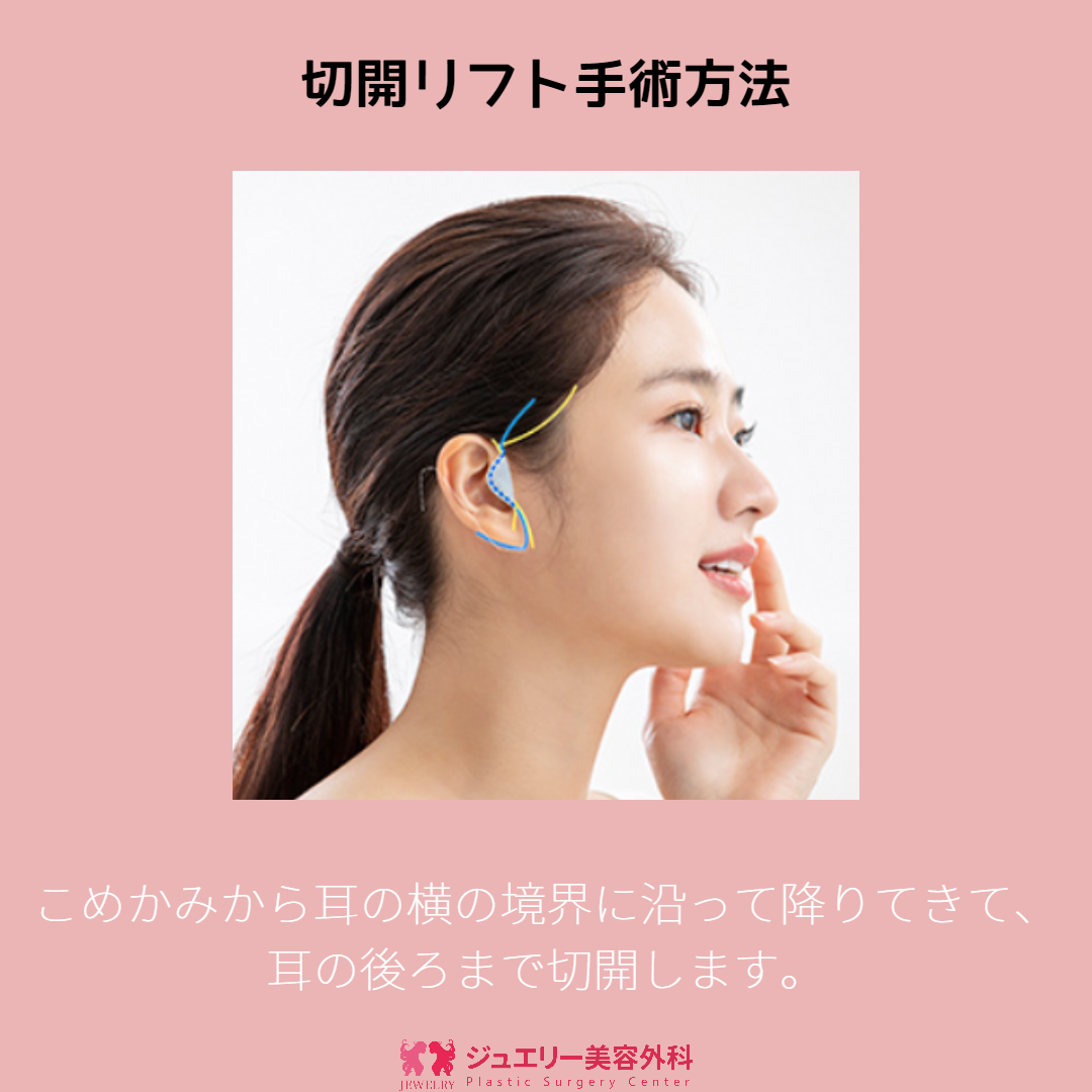 童顔になる秘密!ジュエリー韓国切開リフト003 | ジュエリー美容外科 こめかみから耳の横の境界に沿って降りてきて、耳の後ろまで切開します