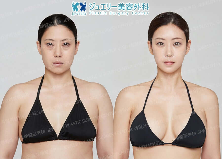 韓国豊胸整