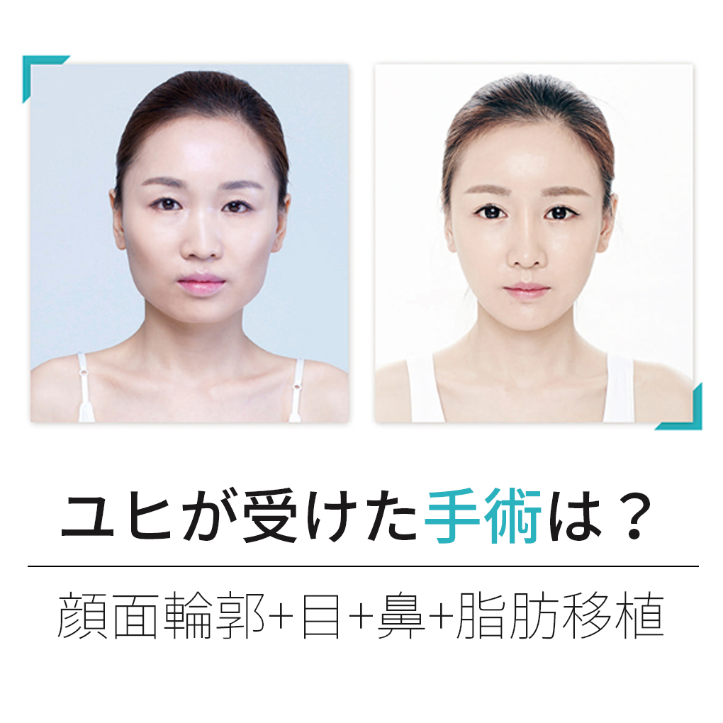 ジュエリーモデル“ユヒ”の整形リアルストーリー 01 | ジュエリー美容外科