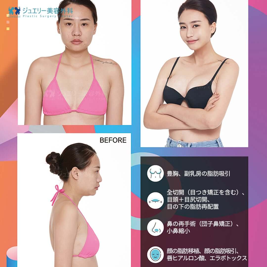 韓国豊胸整形_03 | ジュエリー美容外科 韓国豊胸整形