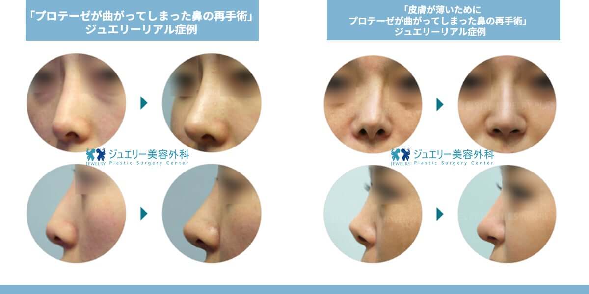 韓国鼻の再手術_05 | ジュエリー美容外科 韓国鼻の再手術