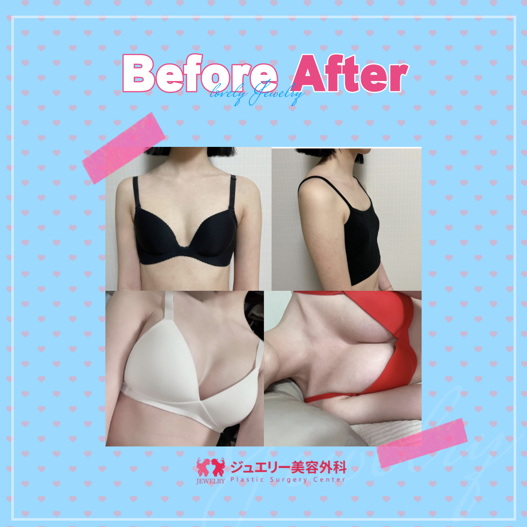 豊胸 | リアルストーリー