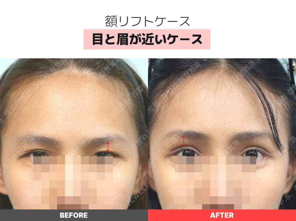 01-01 目と眉が近いケース | ジュエリー美容外科 額リフトの症例写真(目と眉が近いケース)。術前(BEFORE)は眉が低く、目との距離が近いため重たい印象ですが、術後(AFTER)は眉が引き上げられ、目元が明るくスッキリとした印象に変化しています。