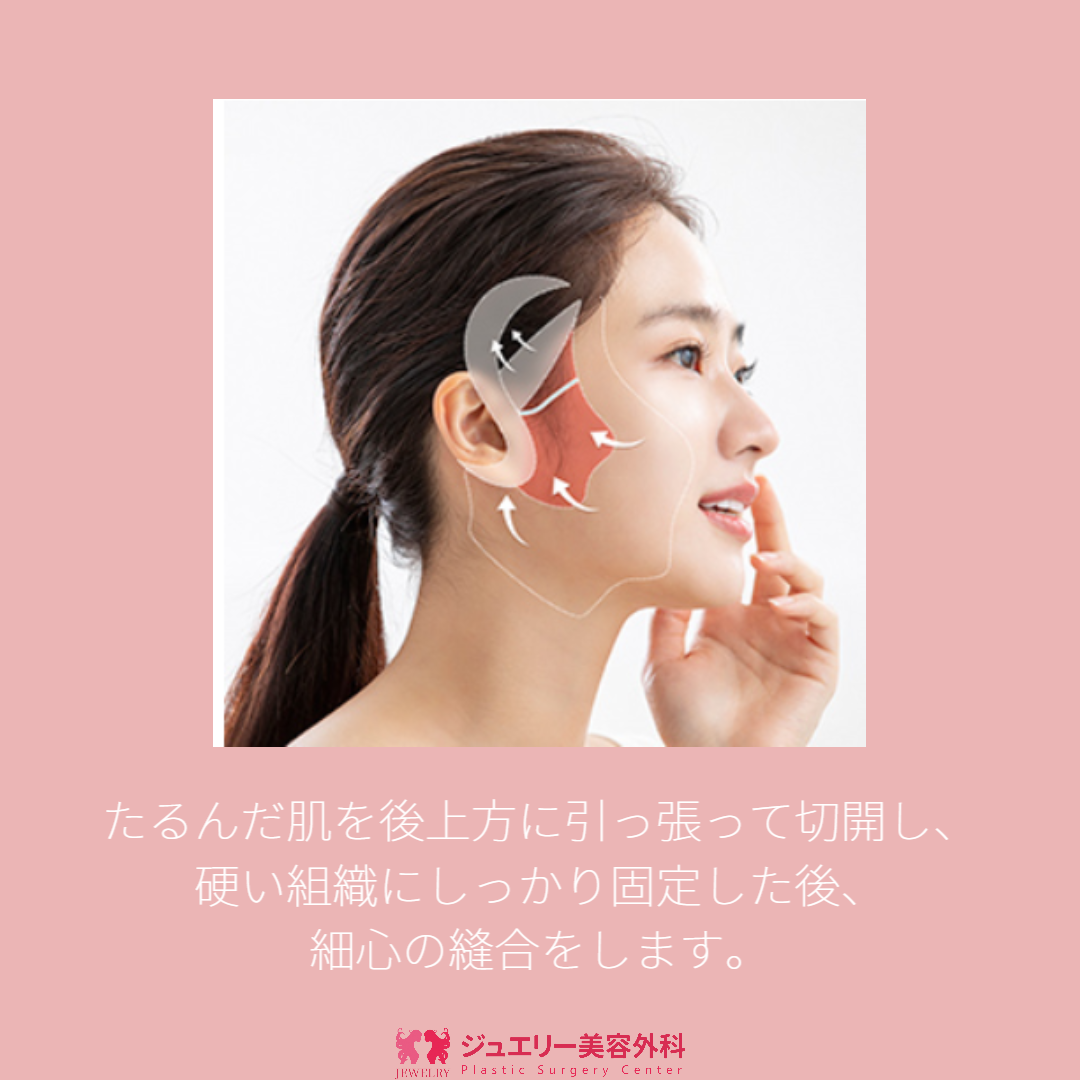 童顔になる秘密!ジュエリー韓国切開リフト006 | ジュエリー美容外科 たるんだ肌を後上方に引っ張って切開し、硬い組織にしっかり固定した後、細心の縫合をします