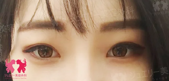韓国目整形