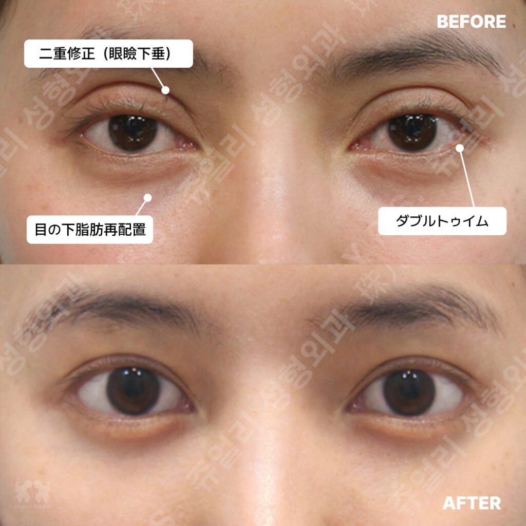 02 二重修正眼瞼下垂+目の下脂肪再配置+ダブルトゥイム | ジュエリー美容外科