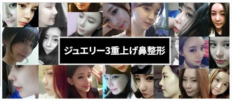 韓国 鼻整形 おすすめ_06 | ジュエリー美容外科 韓国 鼻整形 おすすめ