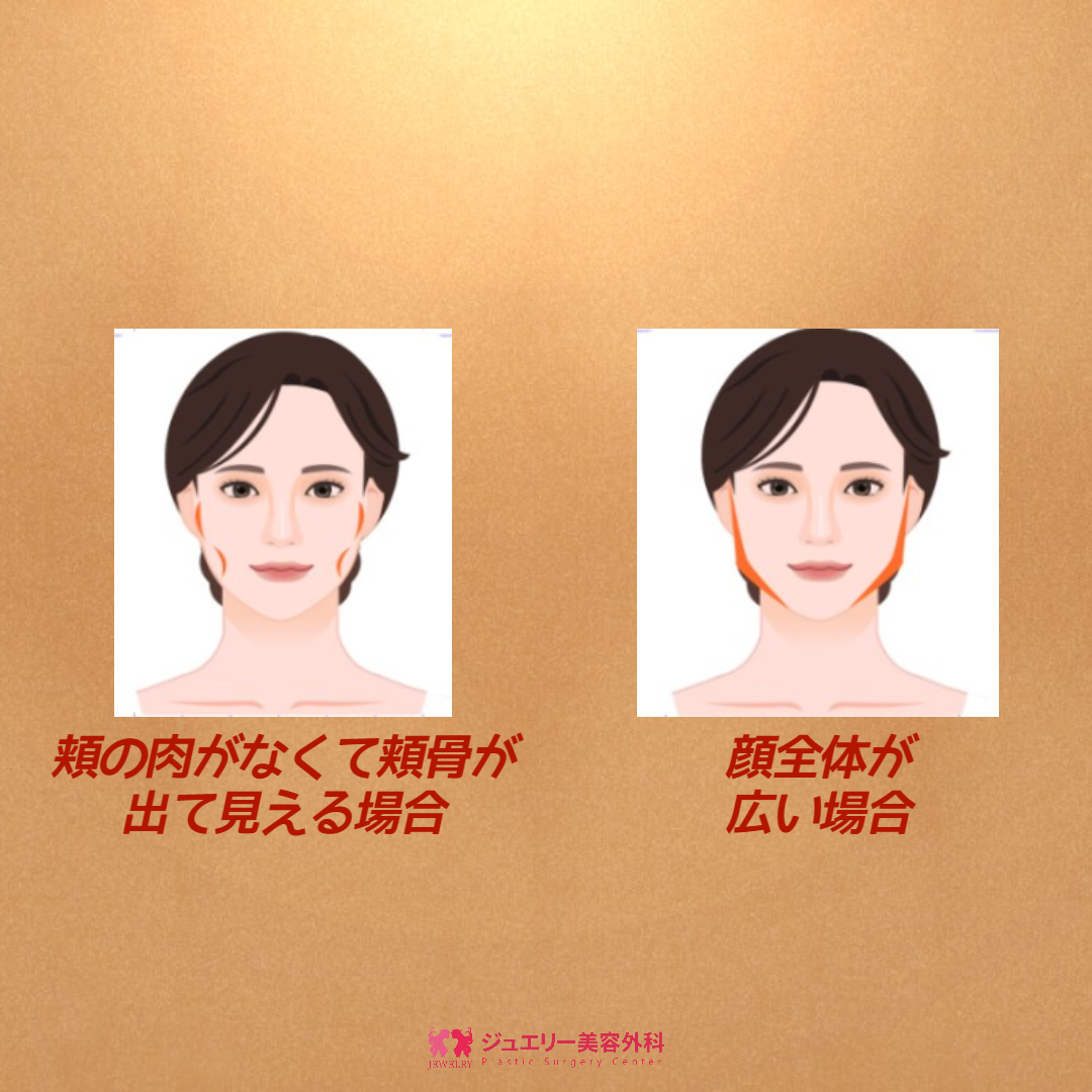 デコボコしたフェイスライン改善・輪郭2点 エラ+頬骨縮小004 | ジュエリー美容外科 頬骨縮小ケース別効果