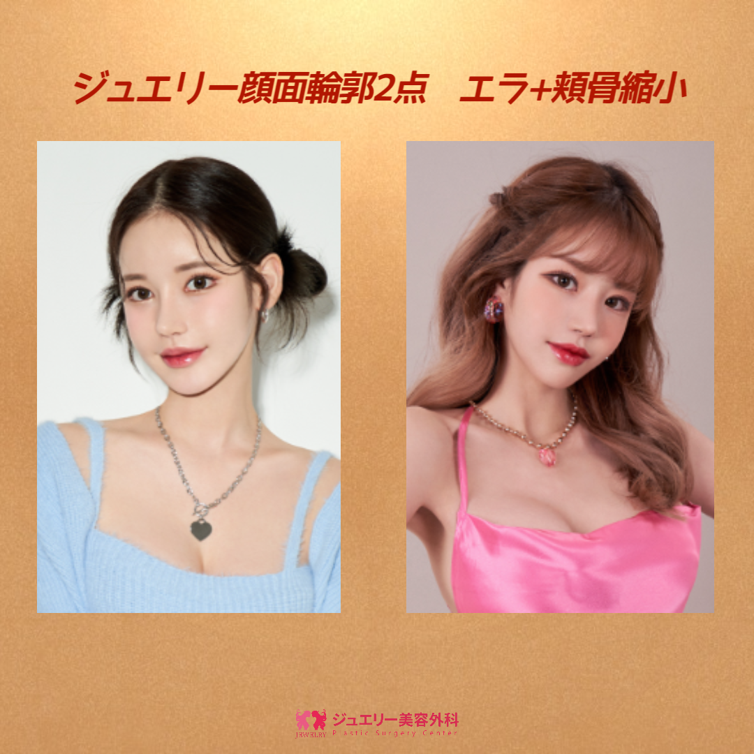 デコボコしたフェイスライン改善・輪郭2点 エラ+頬骨縮小005 | ジュエリー美容外科 デコボコしたフェイスライン改善・輪郭2点 エラ+頬骨縮小