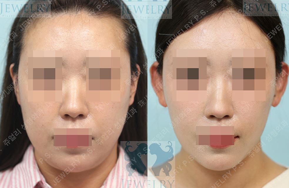 ジュエリー美容外科による**エルフ耳（立ち耳）フィラーのビフォーアフター比較写真。左側の施術前は耳が寝ていて正面から見えにくい状態ですが、右側の施術後はフィラー注入によって耳にボリュームと角度を出し、正面からもしっかり見えるエルフ耳（立ち耳）**になっています。これにより顔の横幅の余白が解消され、小顔効果が得られている様子がわかります。