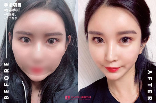 ジュエリー美容外科-顔面輪郭-前後写真 (4) | ジュエリー美容外科 ジュエリー美容外科の顔面輪郭の前後メイン写真です