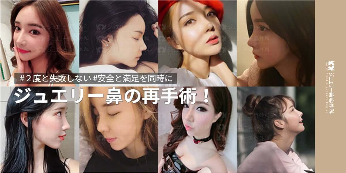 韓国鼻の再手術_03 | ジュエリー美容外科 韓国鼻の再手術