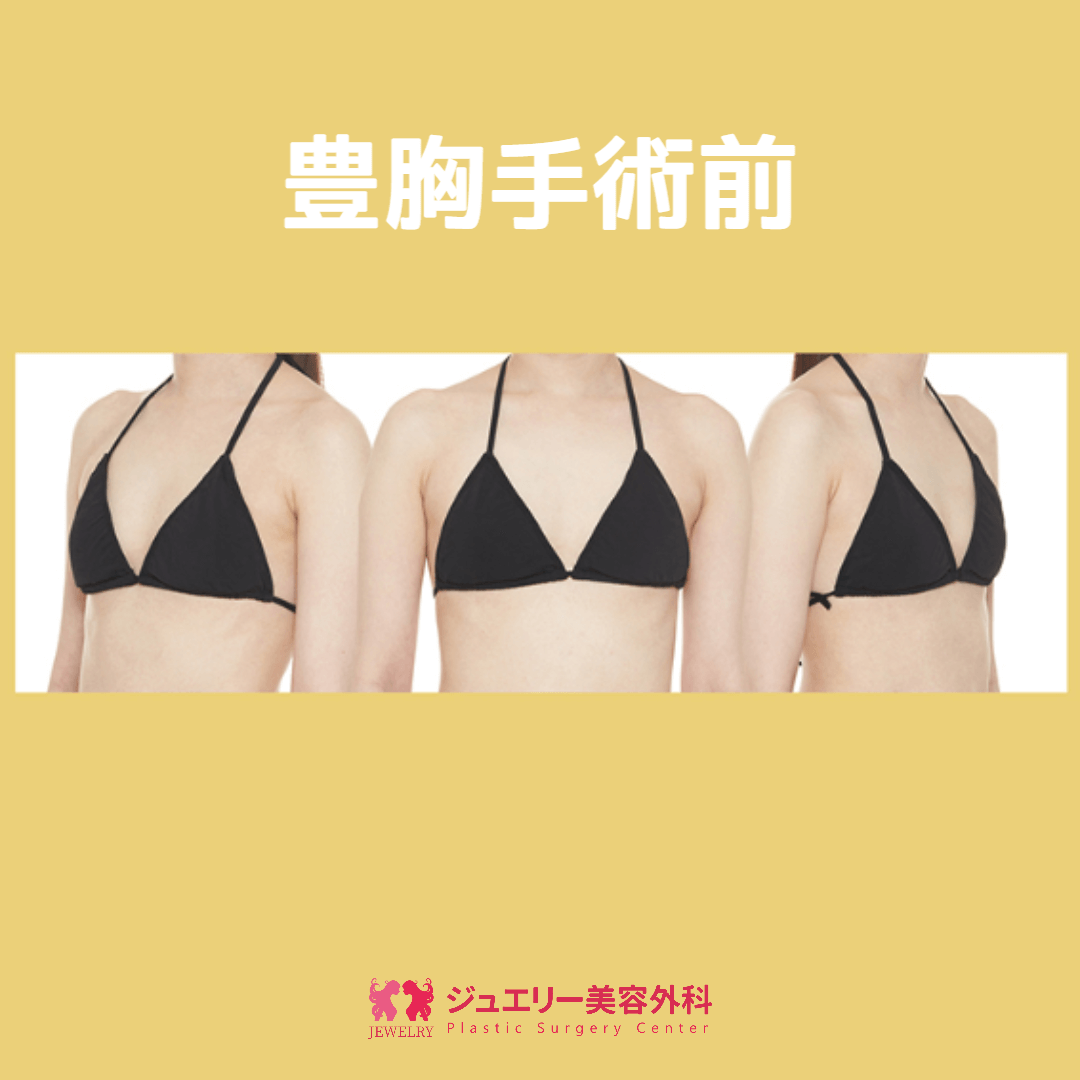 豊胸手術前
