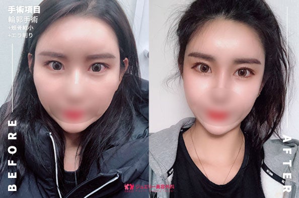 ジュエリー美容外科-顔面輪郭-前後写真 (1) | ジュエリー美容外科 ジュエリー美容外科顔面輪郭手術の三ヶ月目の前後写真