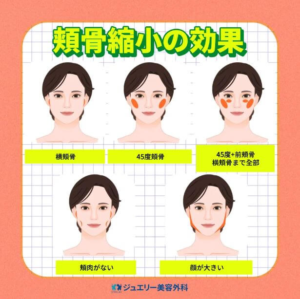 韓国顔面輪郭2点