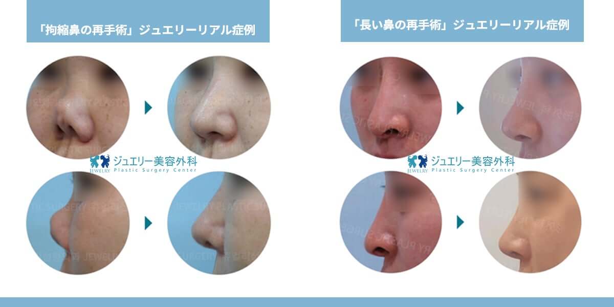 韓国鼻の再手術_04 | ジュエリー美容外科 韓国鼻の再手術