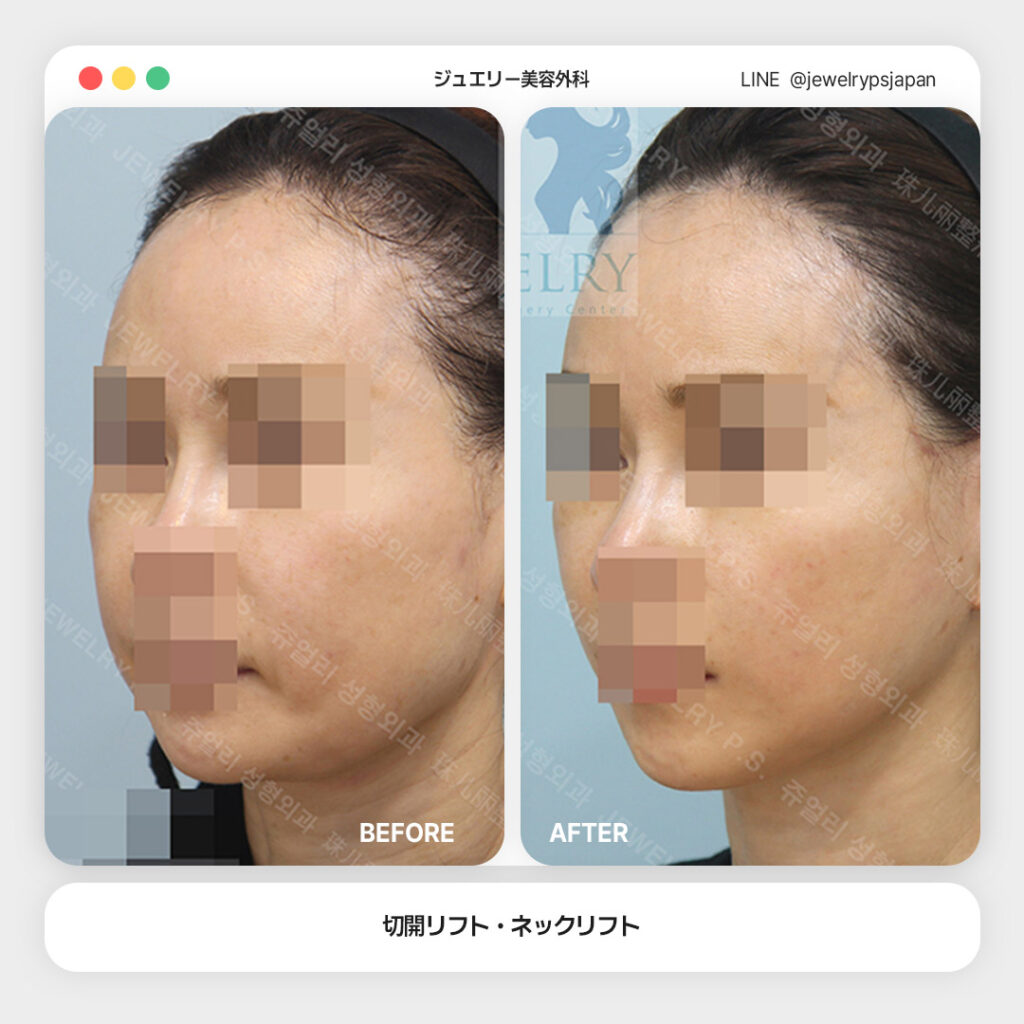 14 切開リフトネックリフト | ジュエリー美容外科 顔の横向き写真。左側は施術前で、頬やフェイスラインにたるみが見られる。右側は施術後で、フェイスラインが引き締まり輪郭がよりシャープに見える。目・口などの個人が特定できる部分はモザイク加工されている。画像下部には「切開リフト・ネックリフト」と書かれている。