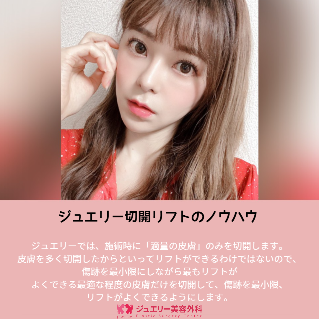 童顔になる秘密!ジュエリー韓国切開リフト002 | ジュエリー美容外科 ジュエリー切開リフト