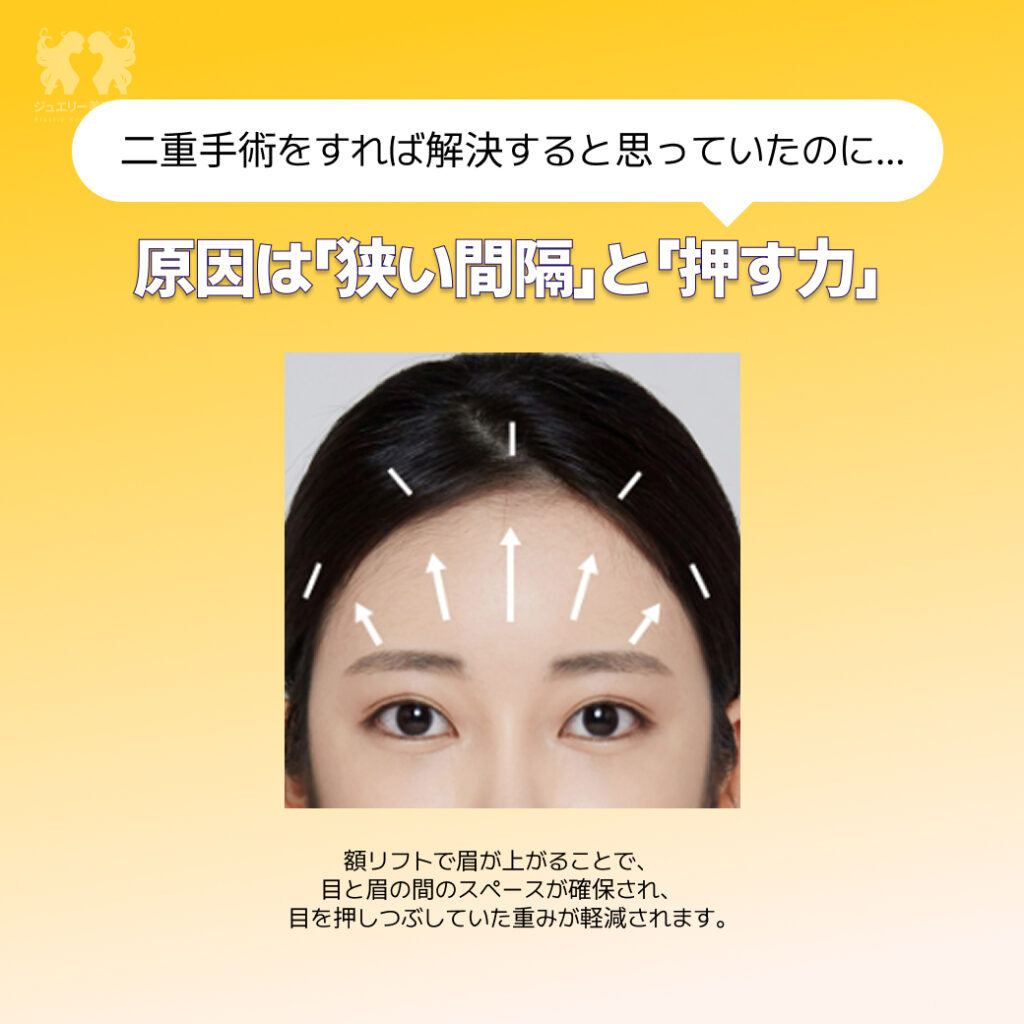 額リフト+内視鏡額リフト+エンドタイン額挙上02 | ジュエリー美容外科 額リフトの効果を説明する画像。上部の吹き出しに「二重手術をすれば解決すると思っていたのに…」とあり、その下に「原因は『狭い間隔』と『押す力』」という見出しがある。中央には、眉毛から額にかけて上向きの矢印が描かれた女性の目元のアップ写真。下部には「額リフトで眉が上がることで、目と眉の間のスペースが確保され、目を押しつぶしていた重みが軽減されます」という解説文が記載されている。