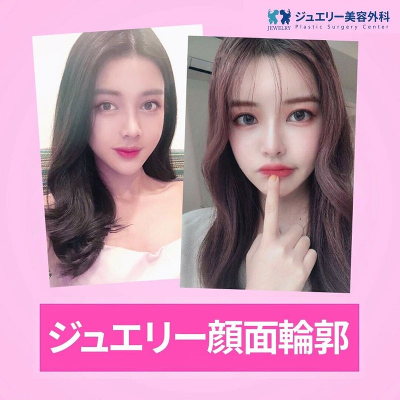 韓国顔面輪郭手術, 骨の構造に合わせた1:1デザイン