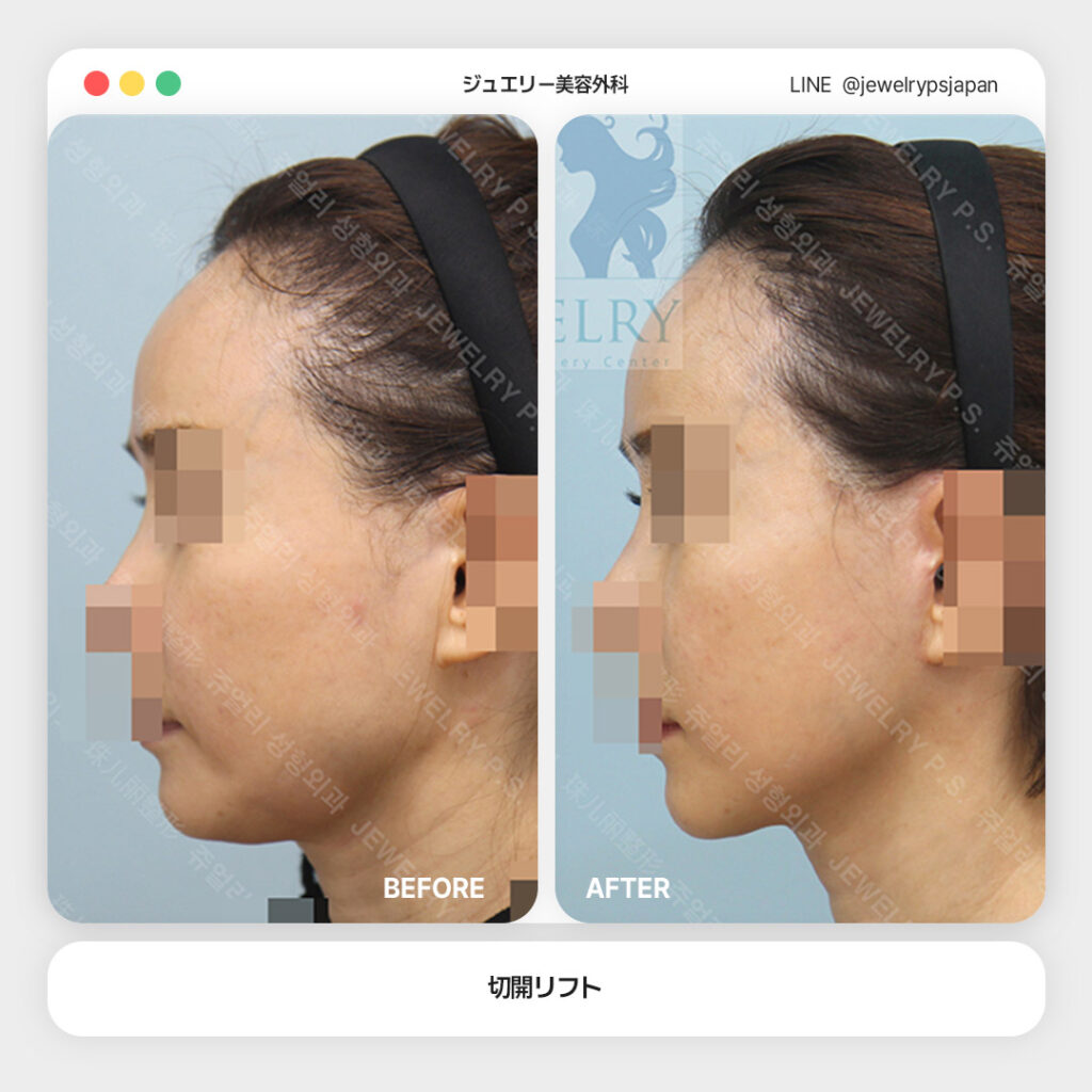 15 切開リフト | ジュエリー美容外科 顔の側面のフェイスリフト(切開リフト)の施術前後写真。画像上部には「ジュエリー美容外科」と表記されている。