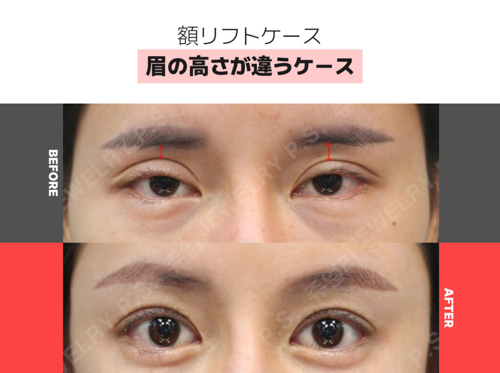 02 眉の高さが違うケース | ジュエリー美容外科 額リフトの症例写真(眉の高さが違うケース)。術前は左右の眉の高さに非対称性が見られますが、術後は左右のバランスが整えられ、均一で自然な眉のラインになっています。
