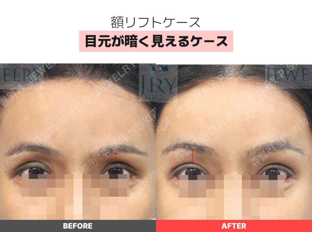 03目元が暗く見えるケース | ジュエリー美容外科 額リフトの症例写真(目元が暗く見えるケース)。眉が下がって影を作っていた術前に比べ、術後は額全体が引き上げられたことで目元に光が入り、表情全体が明るく改善されています。