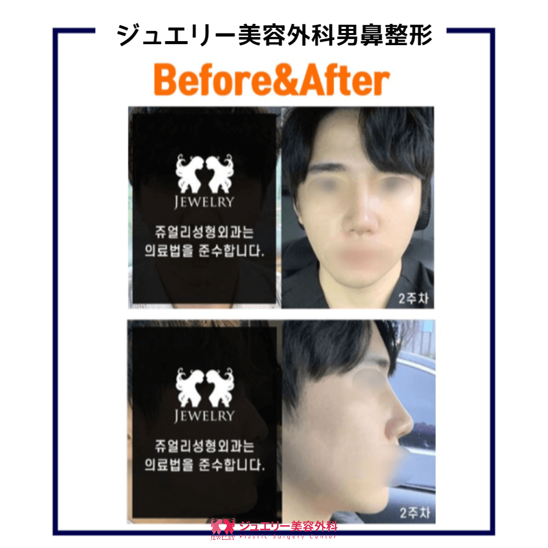 ジュエリー美容外科の男性鼻整形レビュー写真です。